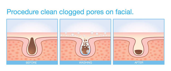 程序清洁堵塞毛孔脸部照片
