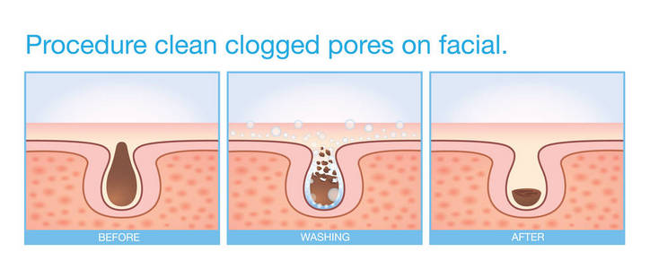 毛孔堵塞示意图图片
