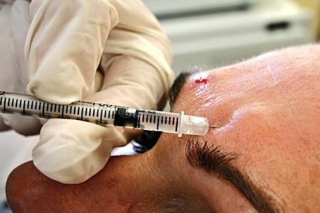 ﹗ 皮肤科医生执行注射肉毒杆菌毒素亚洲小姐脸注射肉毒杆菌毒素医