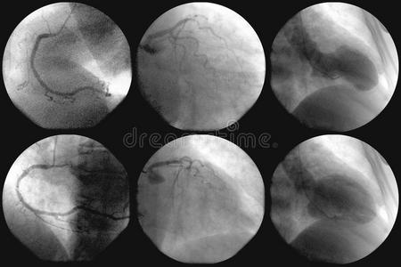 心导管和冠状动脉造影