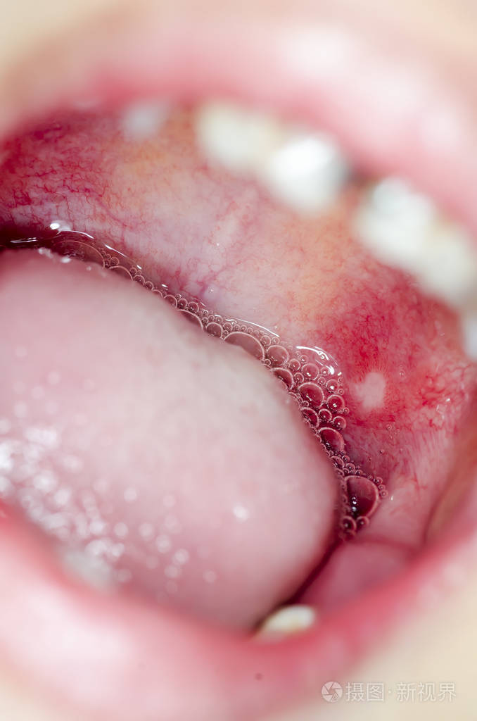 感染的口腔内溃疡