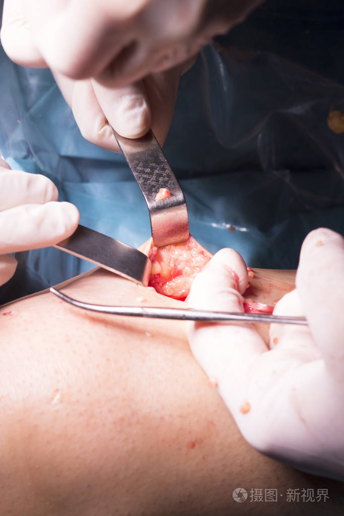 外科手术膝盖手术