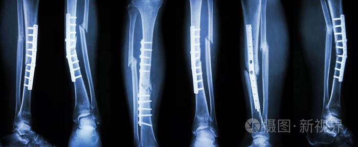 小腿骨折和以钢板螺钉内固定手术治疗的集合形象 打破胫骨和腓骨骨照片 正版商用图片1rjcvk 摄图新视界