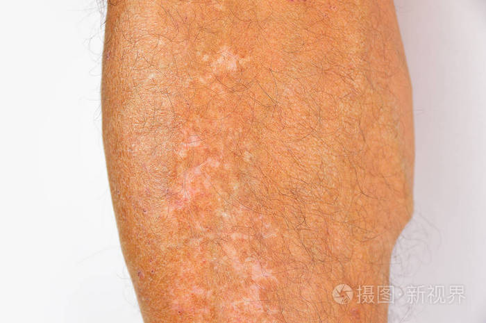 腿上的色素沉着
