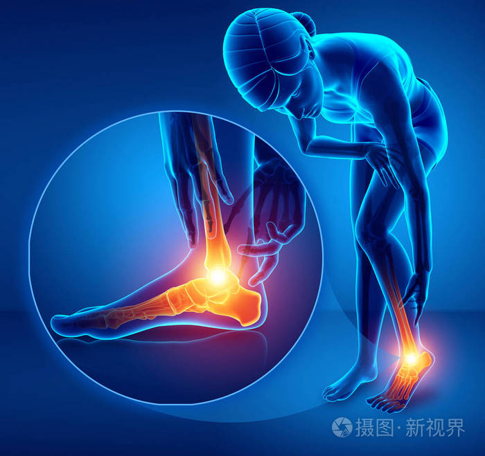 3d插图的女性脚和踝关节疼痛