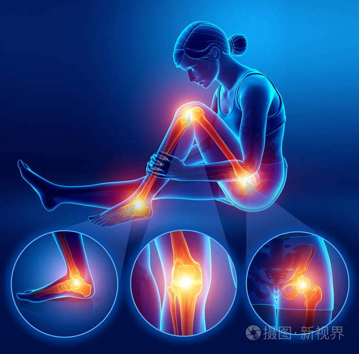 3d 插图的女性感觉腿部疼痛