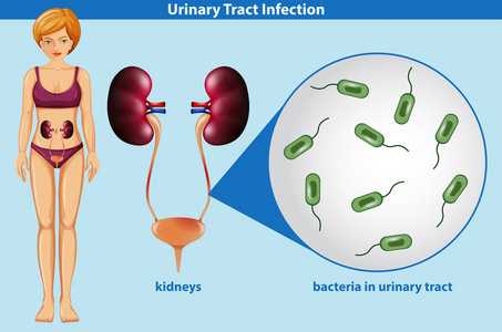 尿路感染图片