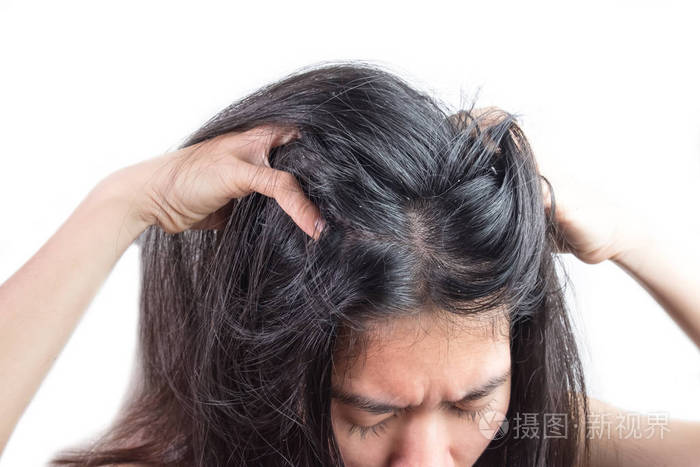 女人头上有头皮屑是由肮脏的问题引起的.