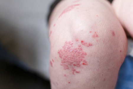 过敏性皮疹皮炎湿疹皮肤病人的腿.银屑病和湿疹皮肤有大红色斑点.