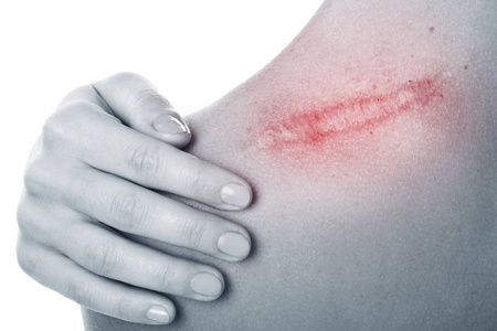 女人的肚子塞满从剖宫产瘢痕的特写女性腹部皮肤有妊娠纹和便便的特写