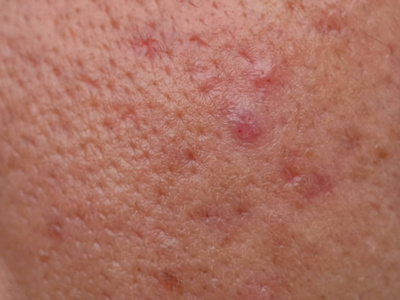 闭合性皮肤问题结节性痤疮皮肤照片