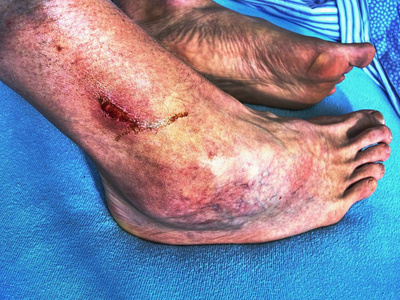 湿磨. 皮肤上的深伤口很详细.照片