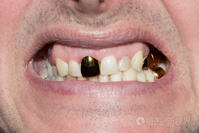 牙科诊所病人口腔内的旧金牙冠