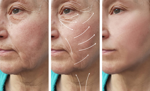 老年妇女面部皱纹矫正术前后箭头照片