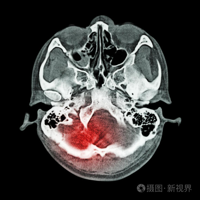 脑损伤，中风脑和颅底ct扫描骨窗