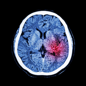 脑CT扫描显示缺血性脑卒中或出血性脑卒中