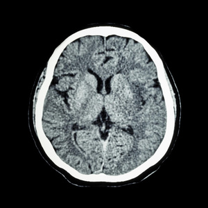 脑CT扫描显示正常人的大脑CAT扫描