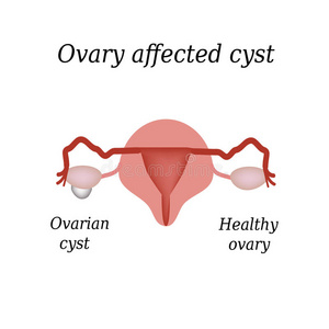 卵巢中的囊肿。 盆腔器官。 矢量