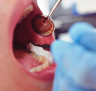 牙医检查病人的嘴