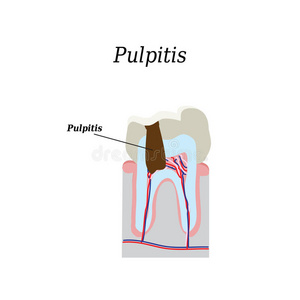 牙髓。 矢量插图上