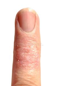 皮炎 手指 成人 特写镜头 照顾 条件 表皮 疾病 神经性皮炎