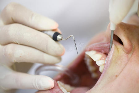 牙周病学 口香糖 照顾 炎症 牙间 口臭 角落 仪器 测量