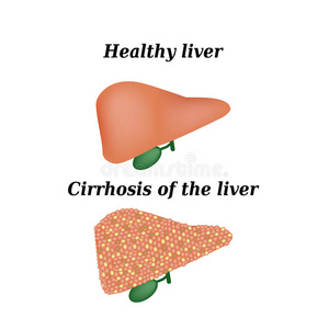 肝硬化。矢量图示打开