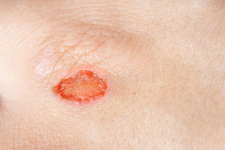 流血的伤口图片-流血的伤口素材-流血的伤口插画-摄图新视界