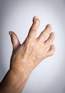 手因类风湿关节炎而变形照片