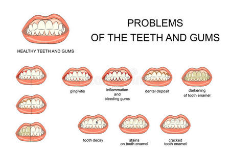 治愈 牙列 尖牙 插图 义齿 炎症 牙科 人类 搪瓷 牙医