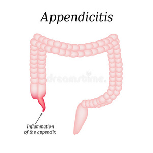 阑尾炎。 阑尾炎。 结肠。 背景上的插图
