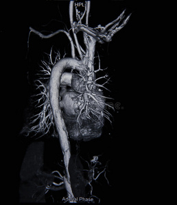 ct扫描血管造影从胶片x射线拍摄照片