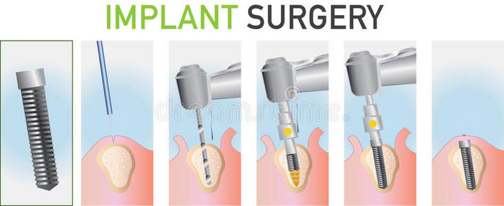 牙科手术插图