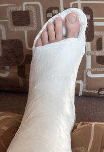 脚踝骨折石膏脚踝骨折照片