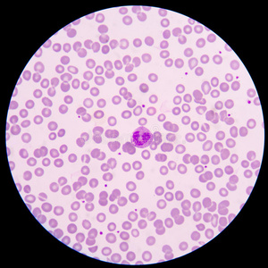 记事本与文本标签血癌 实验室试管的血,血液涂片在显微镜和血在医生桌