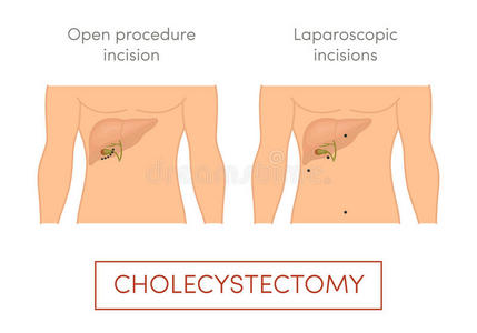 胆囊切除图