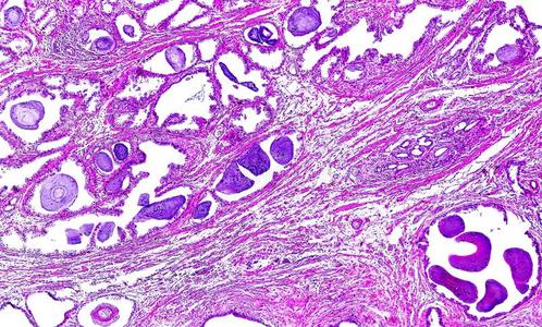 肉瘤的人肝脏的光显微图像平滑肌肉瘤的人肝的插图和显微图像脂肪细胞