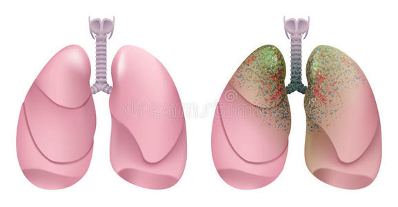 生物学 照顾 解剖 生理学 人类 香烟 呼吸 健康 插图