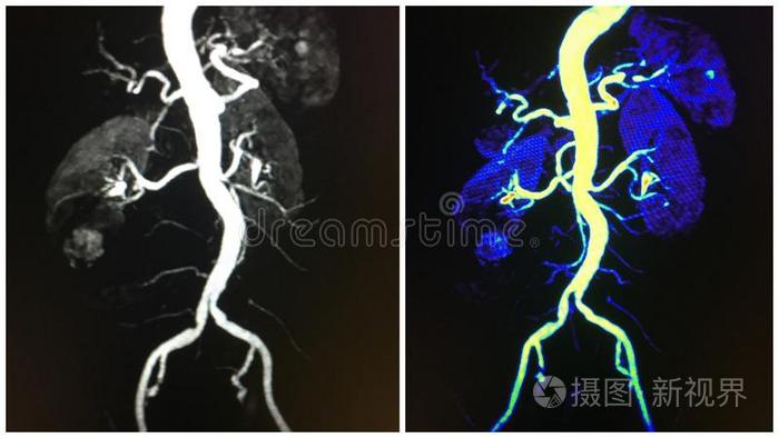 主动脉，肾动脉，肾，MRA胶原