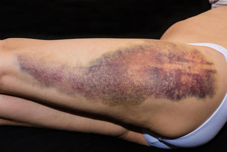 受伤的女人腿上的瘀伤照片
