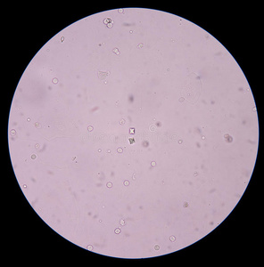 草酸尿中草酸钙晶体照片