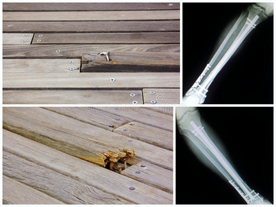 路断了木头木板路断裂导致腿断了照片