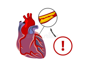 人类 插图 健康 高血压 心脏病学 解剖 冠状动脉 动脉粥样硬化
