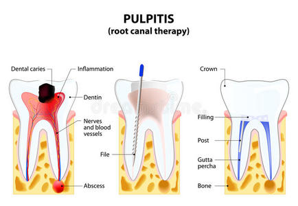 牙本质 填满 搪瓷 脓肿 龋病 教育 运河 人类 牙龈 清洁