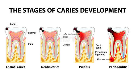 运河 搪瓷 图表 牙本质 感染 人类 牙科 解剖 炎症 脓肿