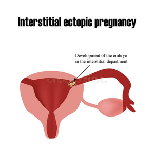 间质部胚胎的发育。 异位妊娠。 信息图表。 矢量插图