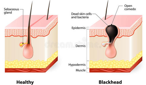表皮 人类 健康 医学 形成 喜剧演员 插图 头发 痤疮