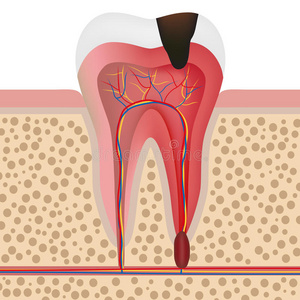 治疗 口腔医学 脓肿 牙医 牙周病 牙髓炎 龋病 人类 纸浆