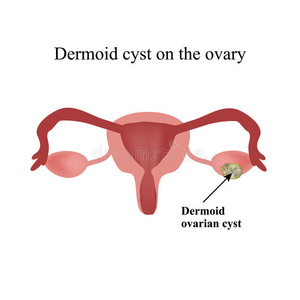 卵巢上的皮样囊肿。