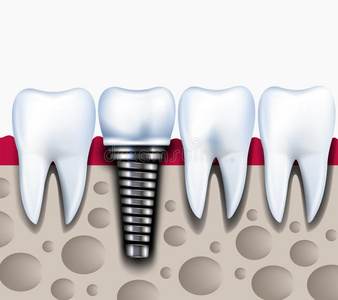 健康牙齿解剖与颌骨种植体。